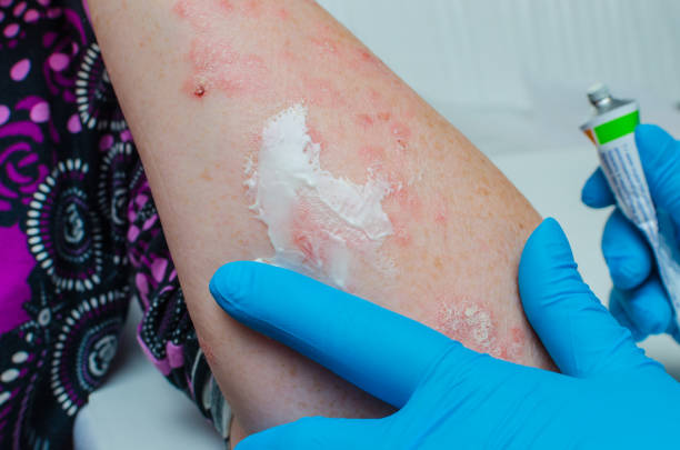A Nurse applying lotion on the effected psoriasis area on the hand