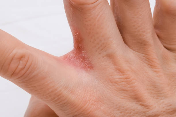A psoriasis affected area in between the fingers